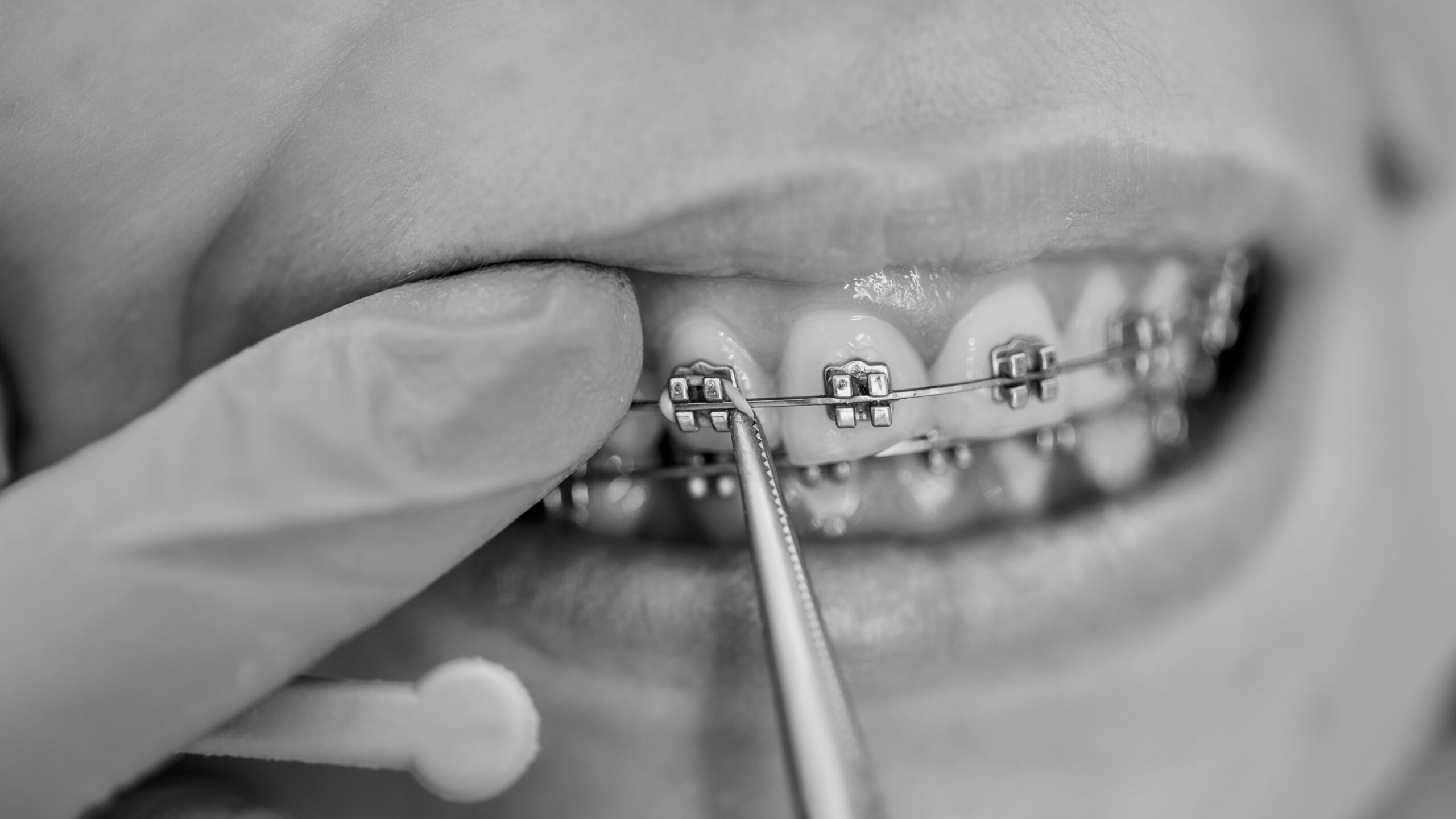 Braces