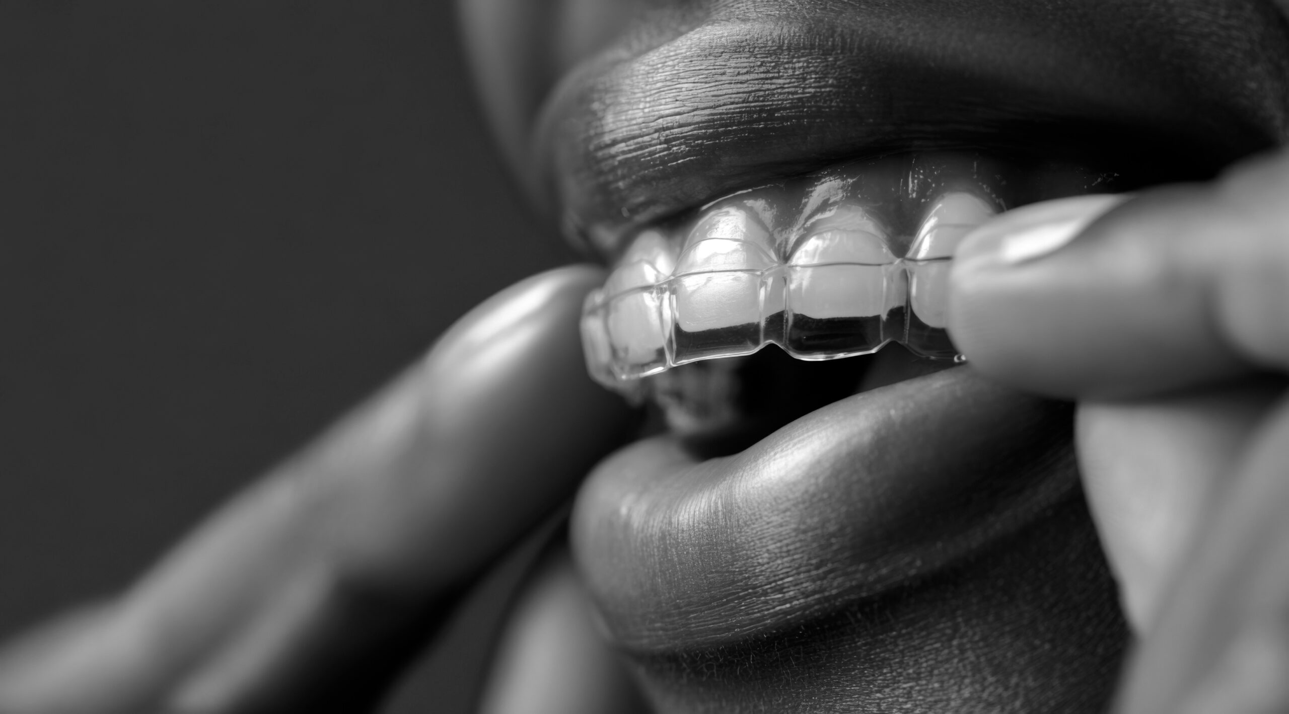 Person is carefully removing a transparent plastic aligner tray from the upper teeth, demonstrating the process of wearing orthodontic devices for straightening teeth and improving oral health